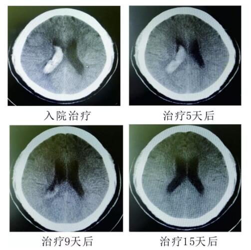腦出血你不得不引起重視的疾?。。。?></a></div>
               
 					<div   id=