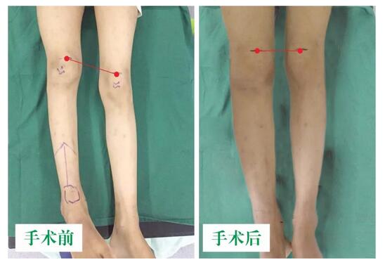 女孩墜梯右腿縮短5cm，幸得醫(yī)生及時診治恢復(fù)正常腿型