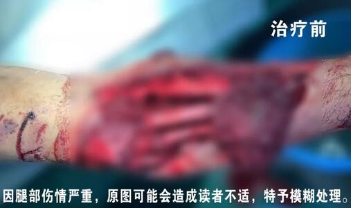 感謝安利醫(yī)院挽救了我的腿，沒有讓我落下殘疾……”