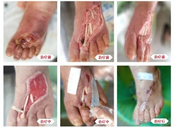 糖尿病并發(fā)癥有多可怕，及時(shí)治療糖尿病足避免截肢！
