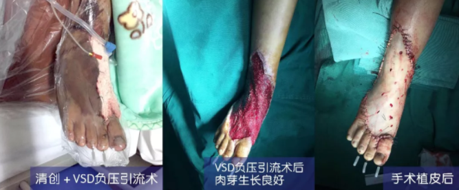 車禍猛如虎，救治如“華佗” ，手術(shù)＋康復(fù)，8歲小女孩車禍后日漸康復(fù)行走