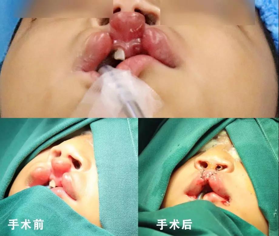 唇腭裂盡早治療消除孩子自卑心理，快樂成長！