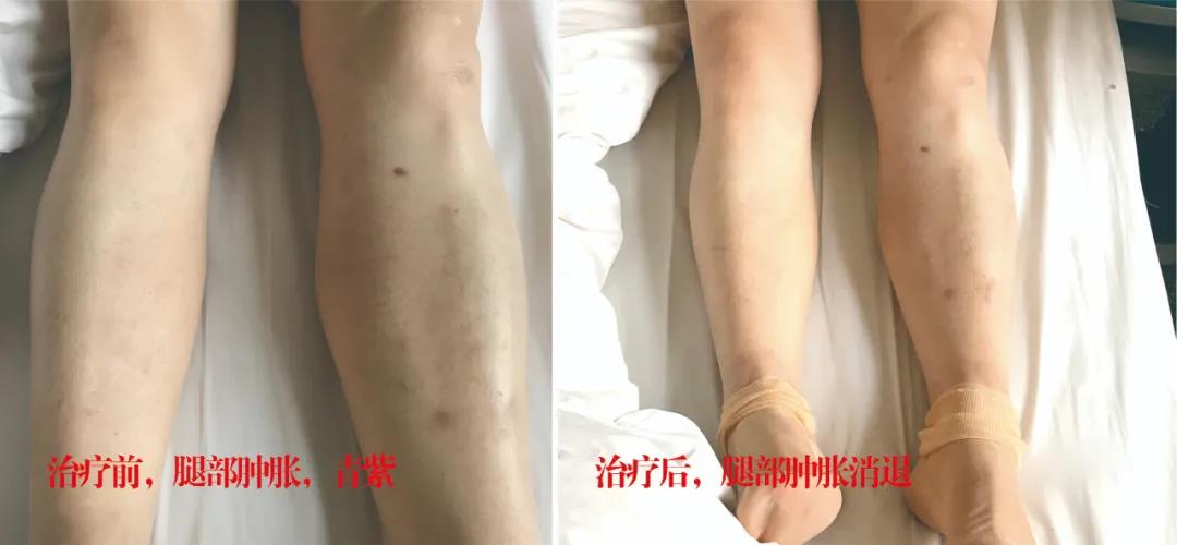 下肢靜脈血栓多年頑疾反復(fù)腫痛——疾病不容等待，早治療，早健康！