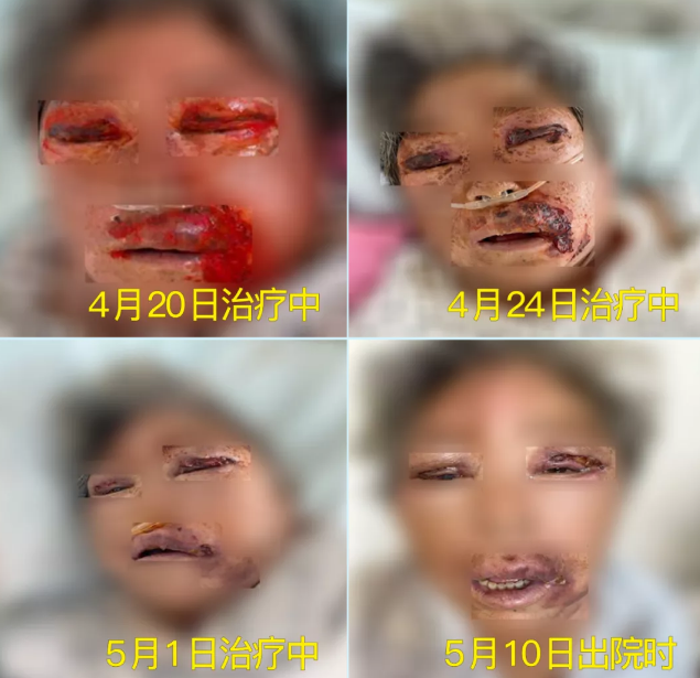 膿毒血癥（急性頜面部蜂窩組織炎）多學科聯(lián)合會診，幫助患者成功治愈！