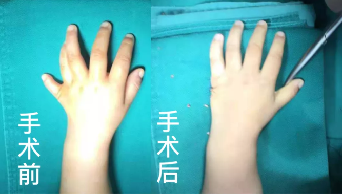 【保山安利醫(yī)院】2歲小兒手、足多指（趾）成功修復(fù)(矯正）！