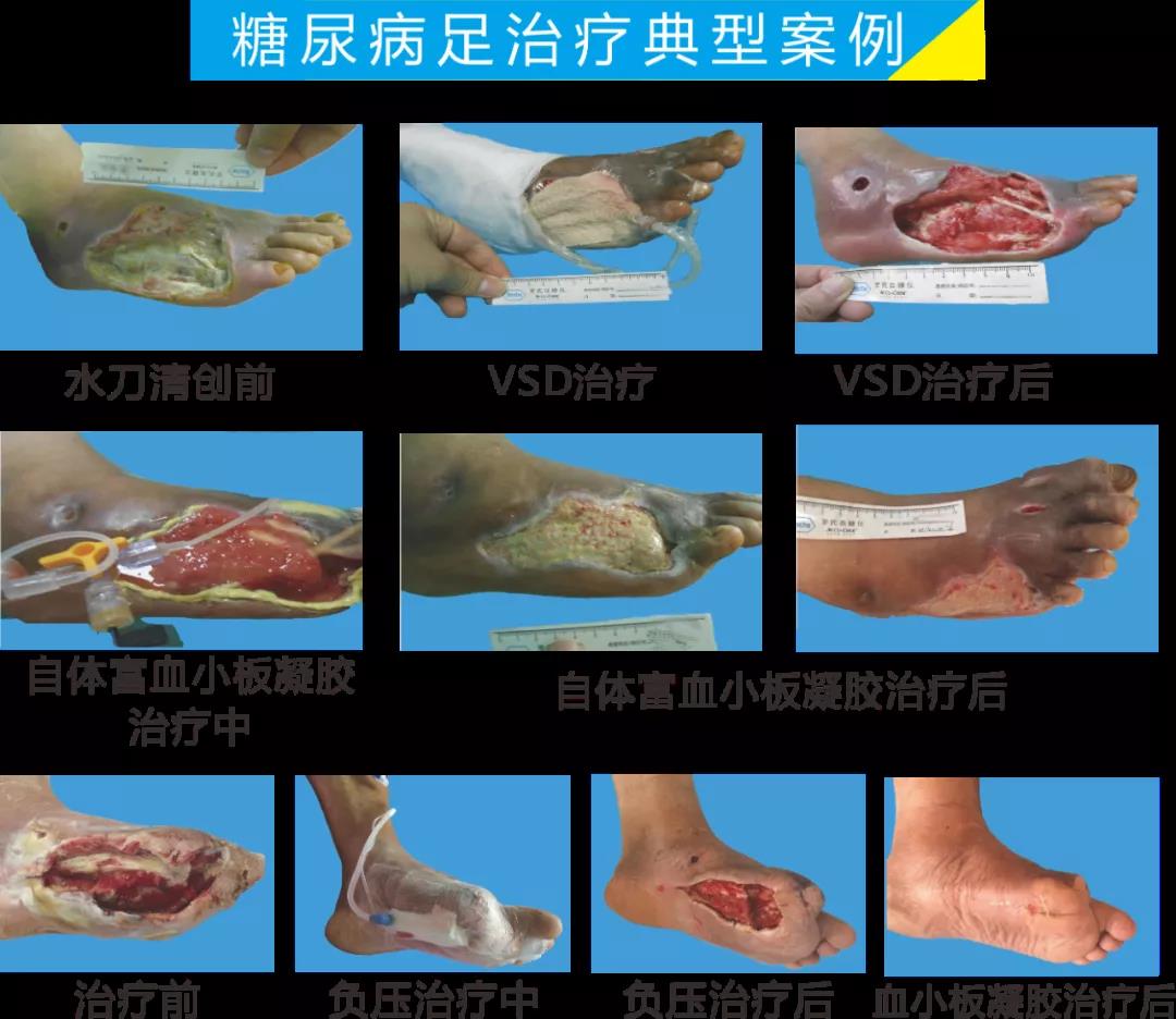 截肢、失明，甚至……，我們要做的是將糖尿病并發(fā)癥遏制在搖籃里！