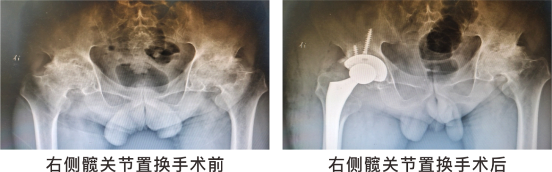 【保山安利醫(yī)院】長(zhǎng)期飲酒導(dǎo)致雙側(cè)股骨頭壞死，髖關(guān)節(jié)置換后重獲運(yùn)動(dòng)功能！